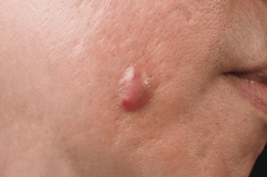 {"en":"Eczema (Atopic Dermatitis)"}
